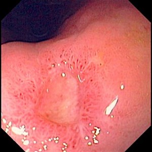 ulcera gastroduodenal